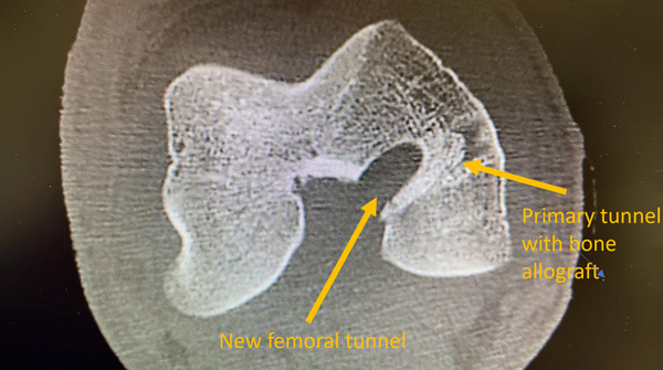 PCL Graft failure