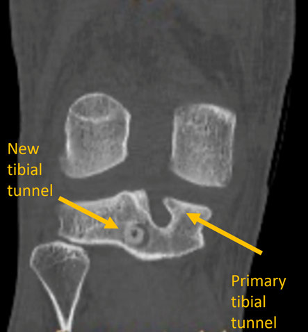 Post-op CT-Scan