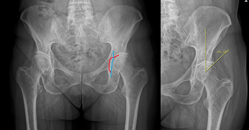 Tonnis 1 Hip osteoarthritis