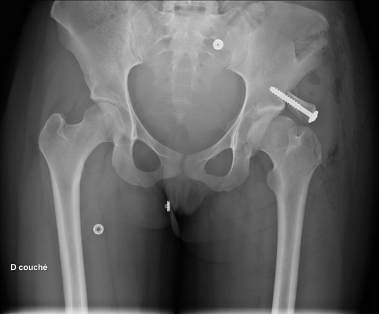 X-ray after index surgery