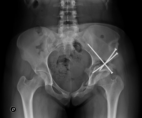 Peri-acetabular oteotomy