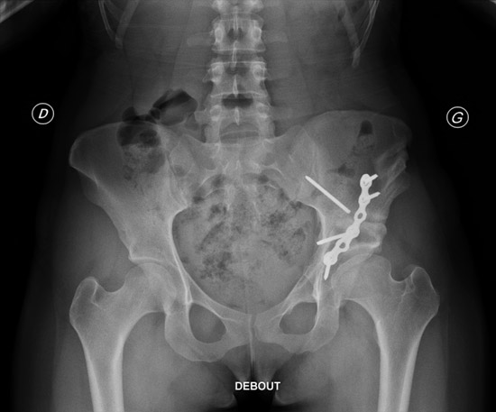 Iliac bone autograft