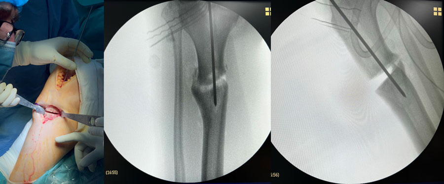 Management of a post-traumatic knee pain: Intra-operative images