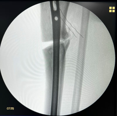 Management of a post-traumatic knee pain: Intra-operative images