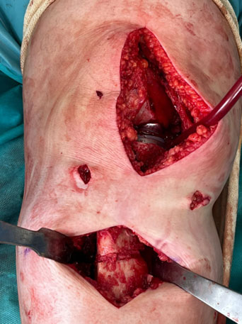 Management of a post-traumatic knee pain: Intra-operative images