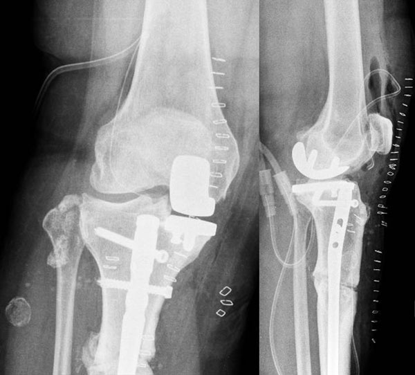 Management of a post-traumatic knee pain: Post-op XRays