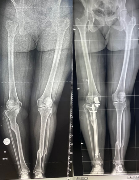 Management of a post-traumatic knee pain: Post-op XRays