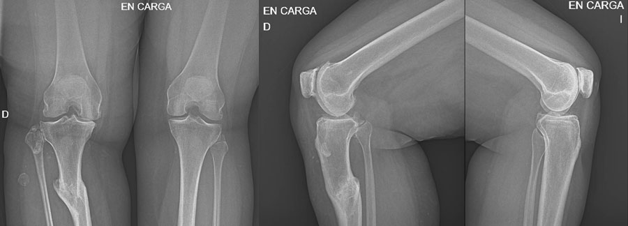 Management of a post-traumatic knee pain: Pre-op XRays