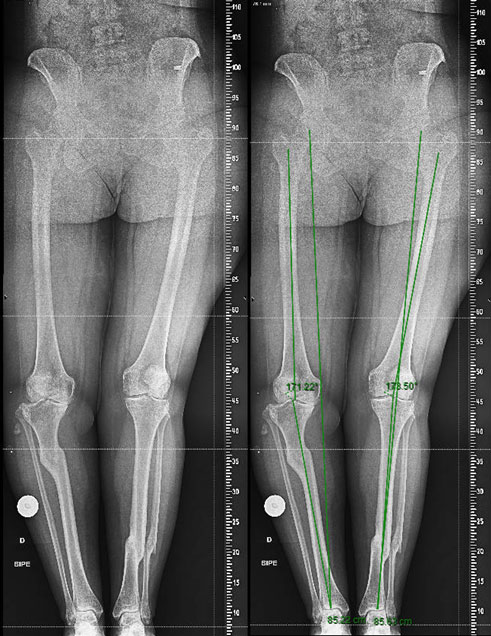 Management of a post-traumatic knee pain: Pre-op XRays