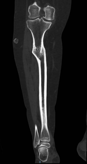 Management of a post-traumatic knee pain: Pre-op CT-scan