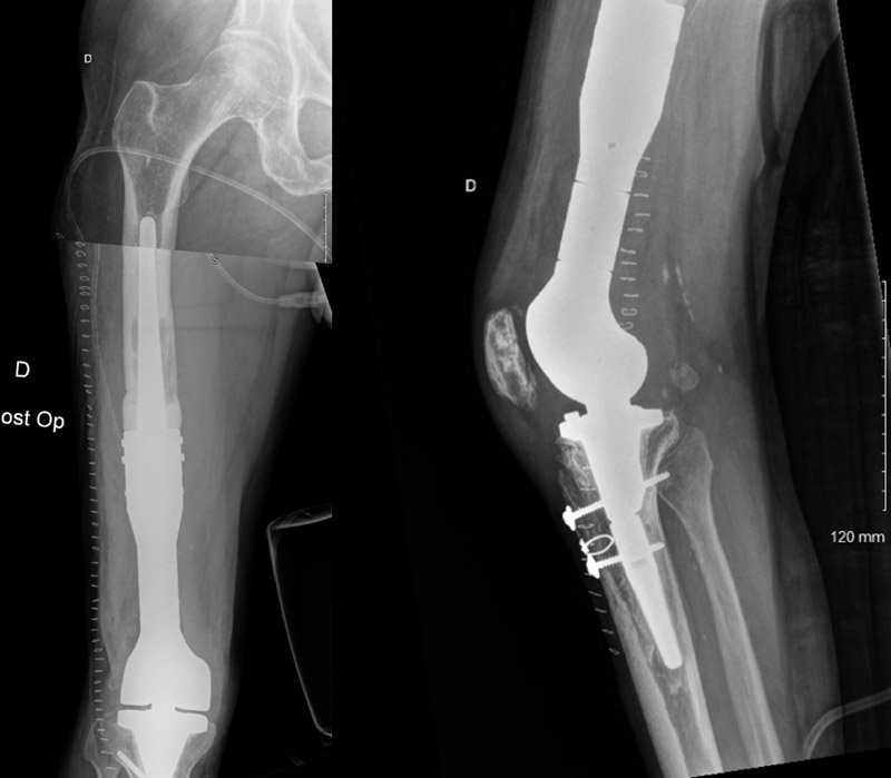 Post-operative X-Rays