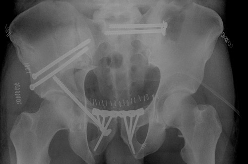 First step: Pelvic ring and anterior column fixation