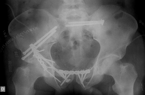 Second step: Posterior column fixation