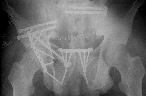 Posterior column fixation