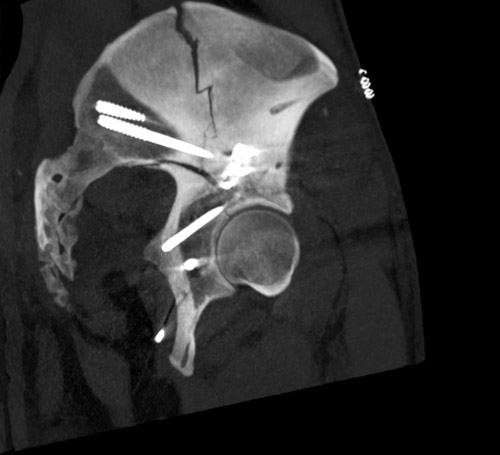 Posterior column fixation