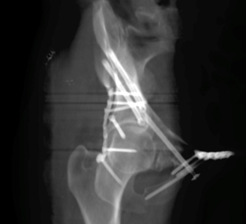 Posterior column fixation