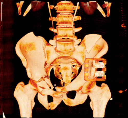 Emergency CT-scan with overthigthened binder