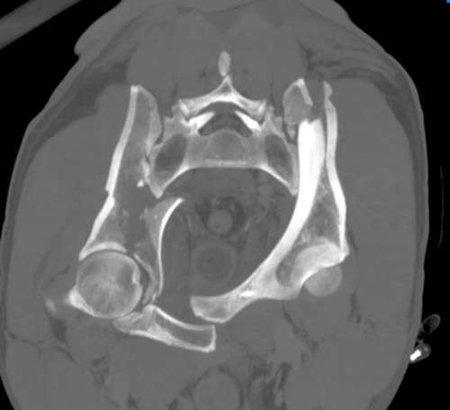 Emergency CT-scan with overthigthened binder