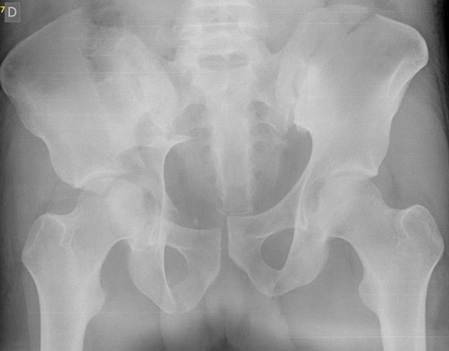 Pre-op X-Rays after applying correct amount of binder compression