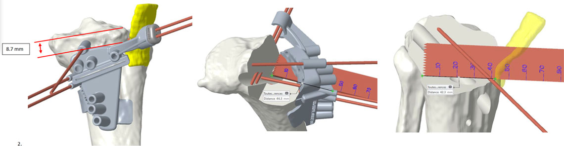 3D Pre-operative planning