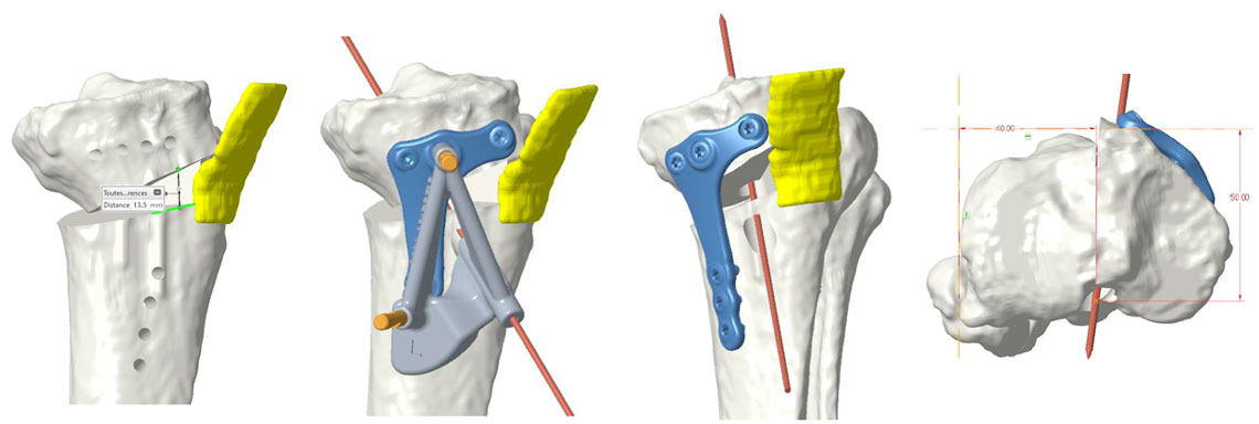 3D Pre-operative planning