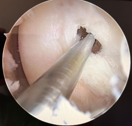 Arthroscopic femoral tunnel drilling