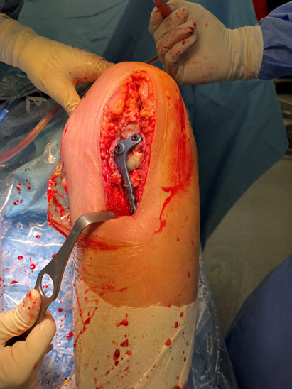 Final aspect after bone grafting and fixation of the posterior tibial tendon allograft