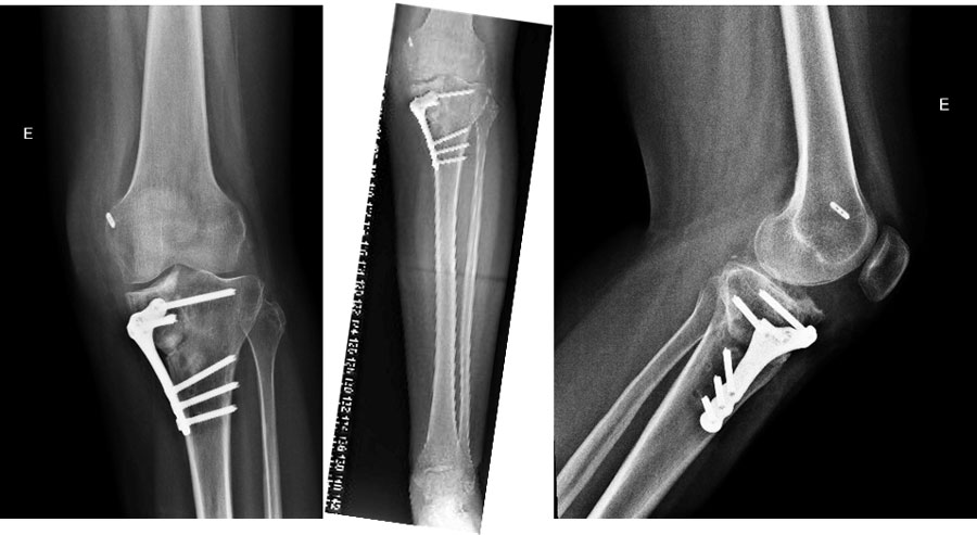 Post-operative X-rays