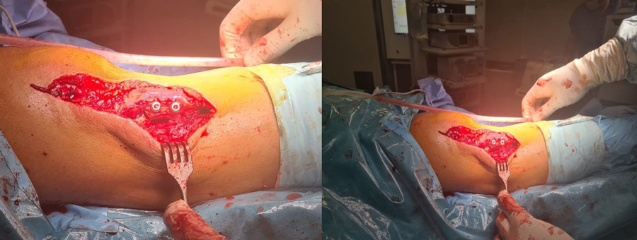 Management of chondral ‘kissing’ lesion of patella and trochlea: Intra-operative pictures