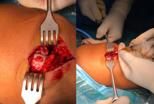 Management of chondral ‘kissing’ lesion of patella and trochlea: Intra-operative pictures