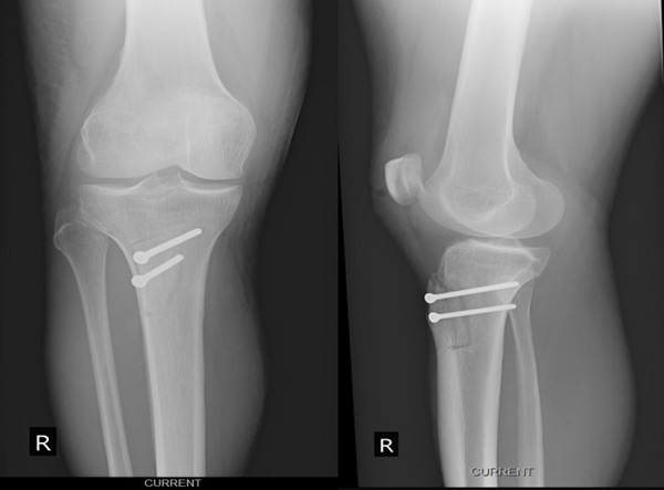 Management of chondral ‘kissing’ lesion of patella and trochlea: Post-operative X-Rays