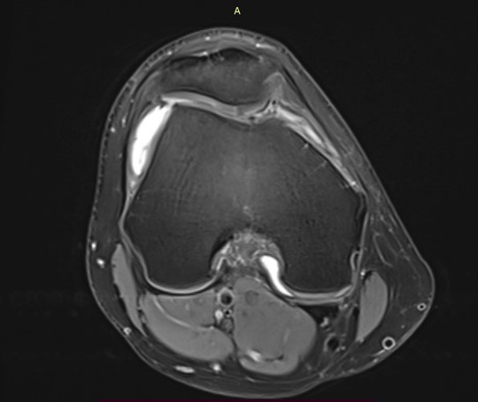 Management of chondral ‘kissing’ lesion of patella and trochlea: MRI 8 months post op