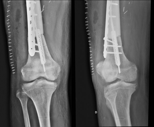 Post-op x-rays