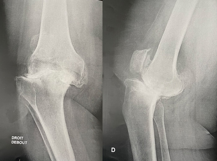 Right knee X-rays