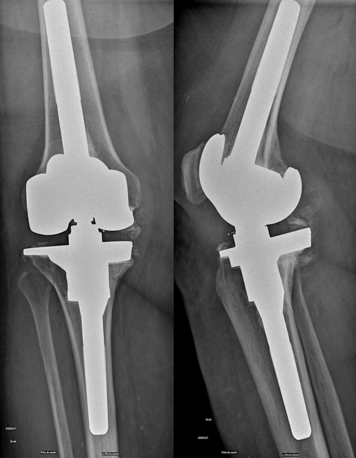 Post-operative x-rays