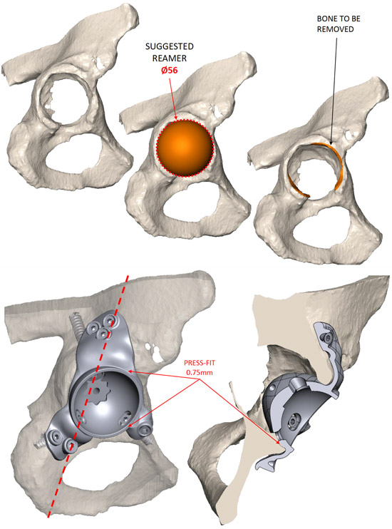 Pre-op planification