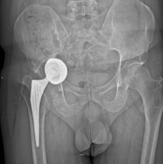 Acetabular cup loosening with severe bone loss : imagery