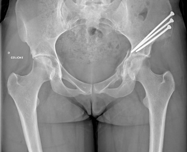Anteverting Peri Acetabular Osteotomy