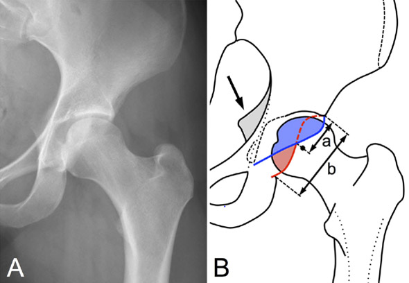 Femoro acetabular impingement Pincer type By TRUE acetabular retroversion 