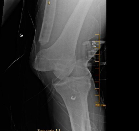 X-Ray at his arrival to the ER