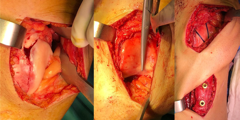 Management of a postoperative persistent patellofemoral instability in a young athlete