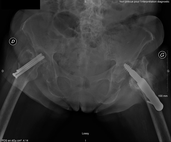 Triple screwing on right femoral neck fracture (2022) DHS plate for left femoral neck fracture (2022), osteonecrosis and secondary displacement (2023)