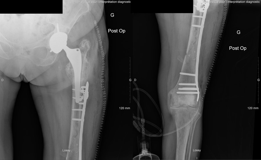 Per operative distal femur fracture requiring plate osteosynthesis