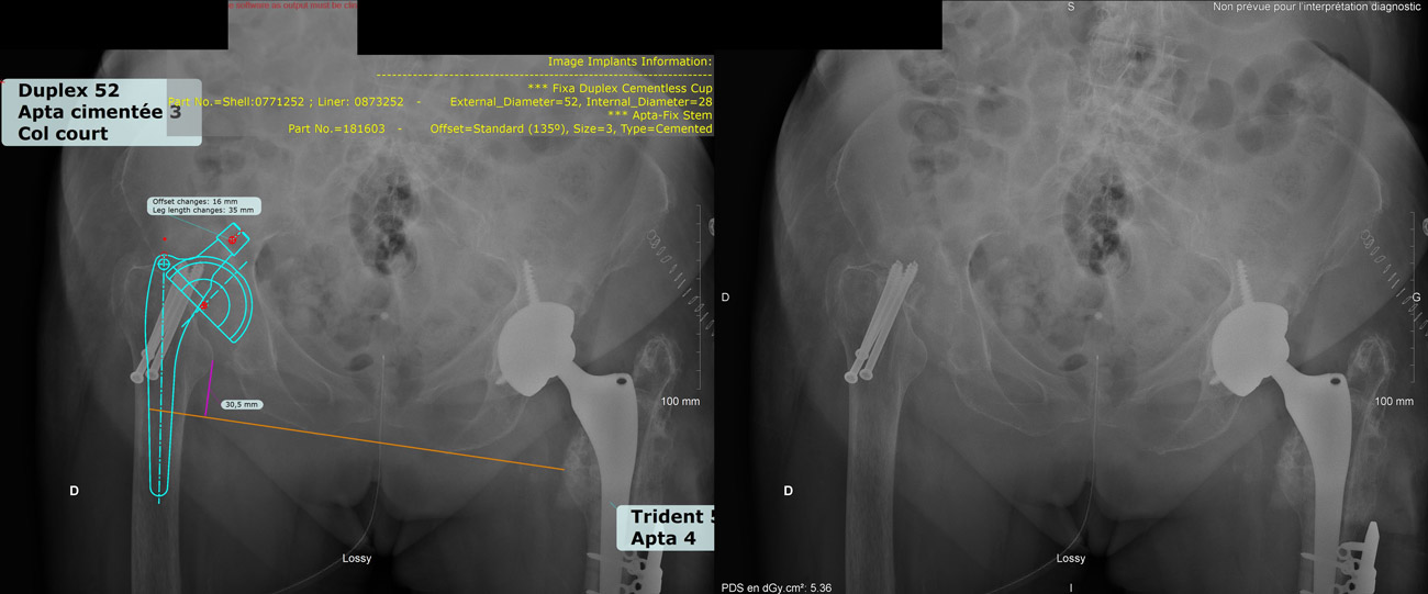 Hip planification of the right hip