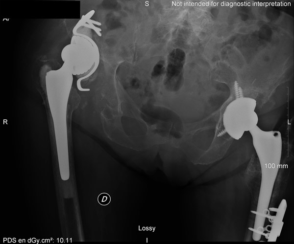 Secondary displacement at one month