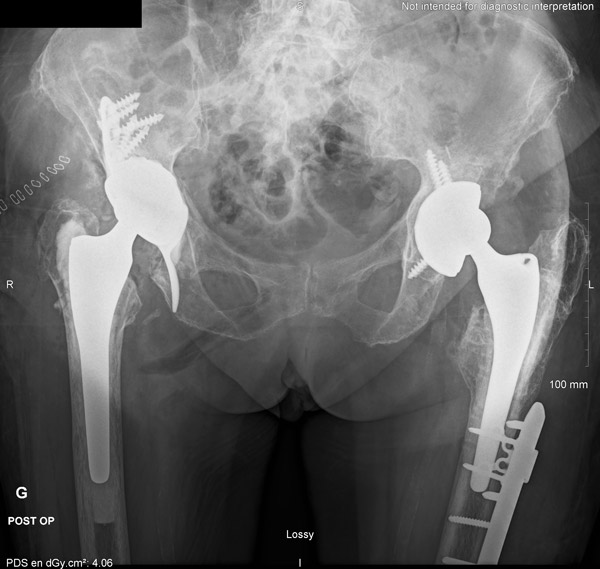 Surgical revision : Burch Schneider ring