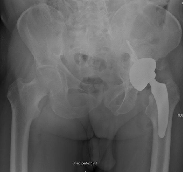 Sequela of an acetabular fracture: : Post-operative X-Ray