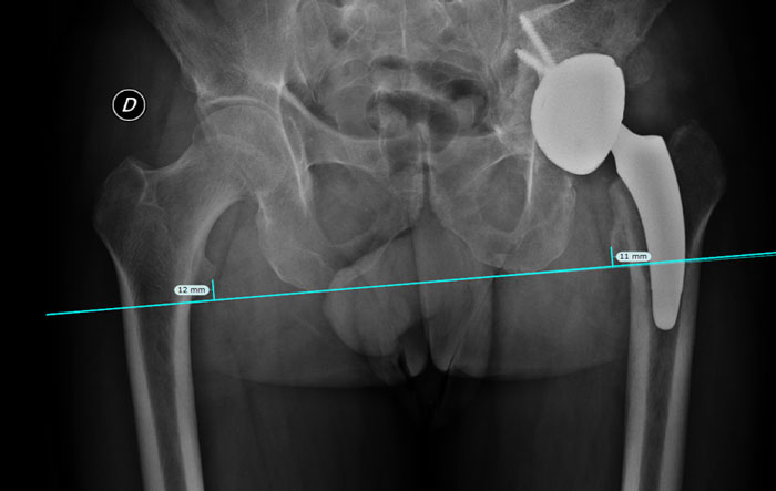 Sequela of an acetabular fracture: Postoperative imagery at 6 weeks