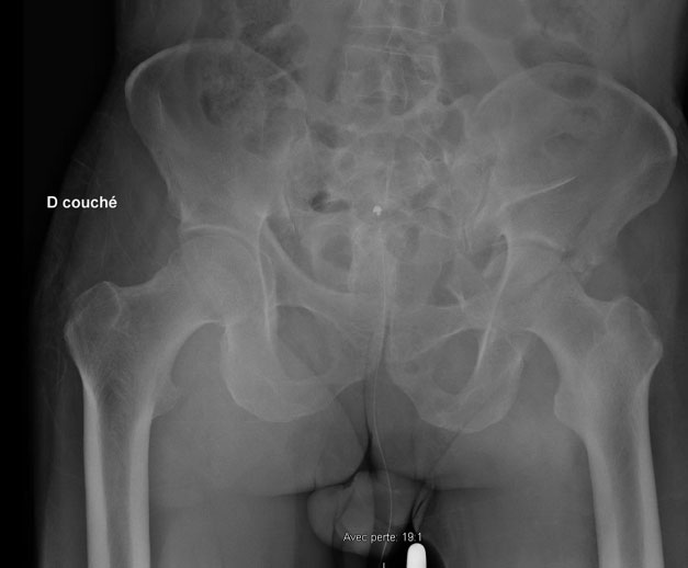 Sequela of an acetabular fracture: Images the day of the trauma