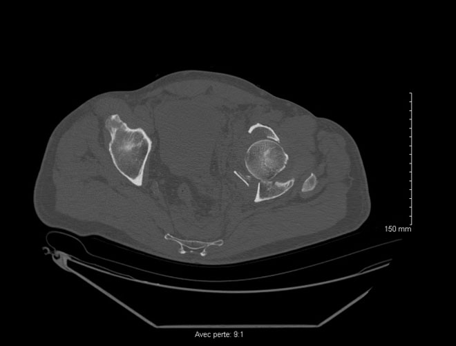 Sequela of an acetabular fracture: Images the day of the trauma